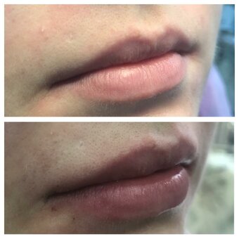 Lip augmentation in the cosmetology studio of Lyudmila Grushko. Sign up for a discount