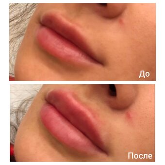 Lip augmentation in the cosmetology studio of Lyudmila Grushko. Sign up for a discount