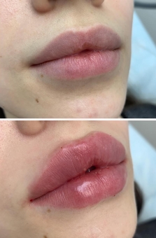 Косметологічний кабінет Олени Кузьменко в Києві. пластика губ акцією.